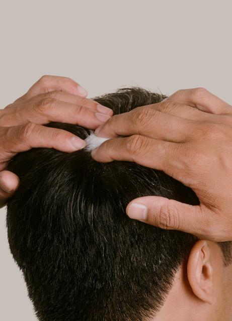 A person applying a topical finasteride and minoxidil product onto the crown of their head