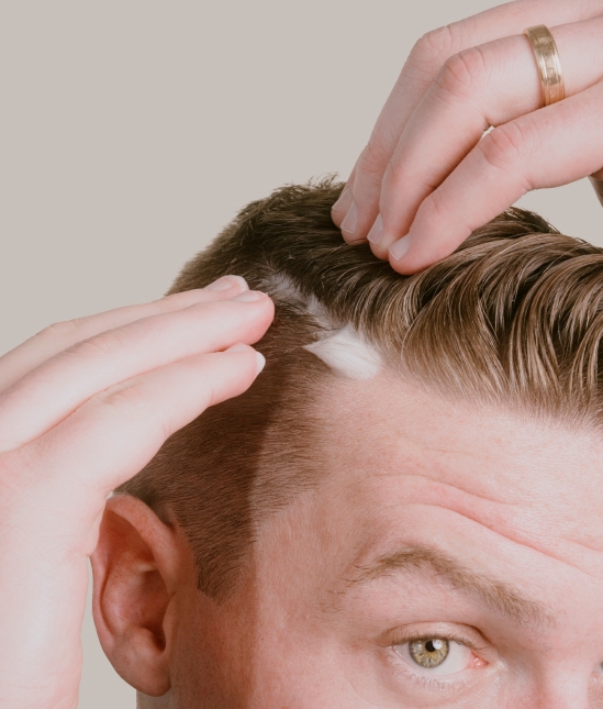 A person applying topical finasteride and minoxidil foam onto their hair