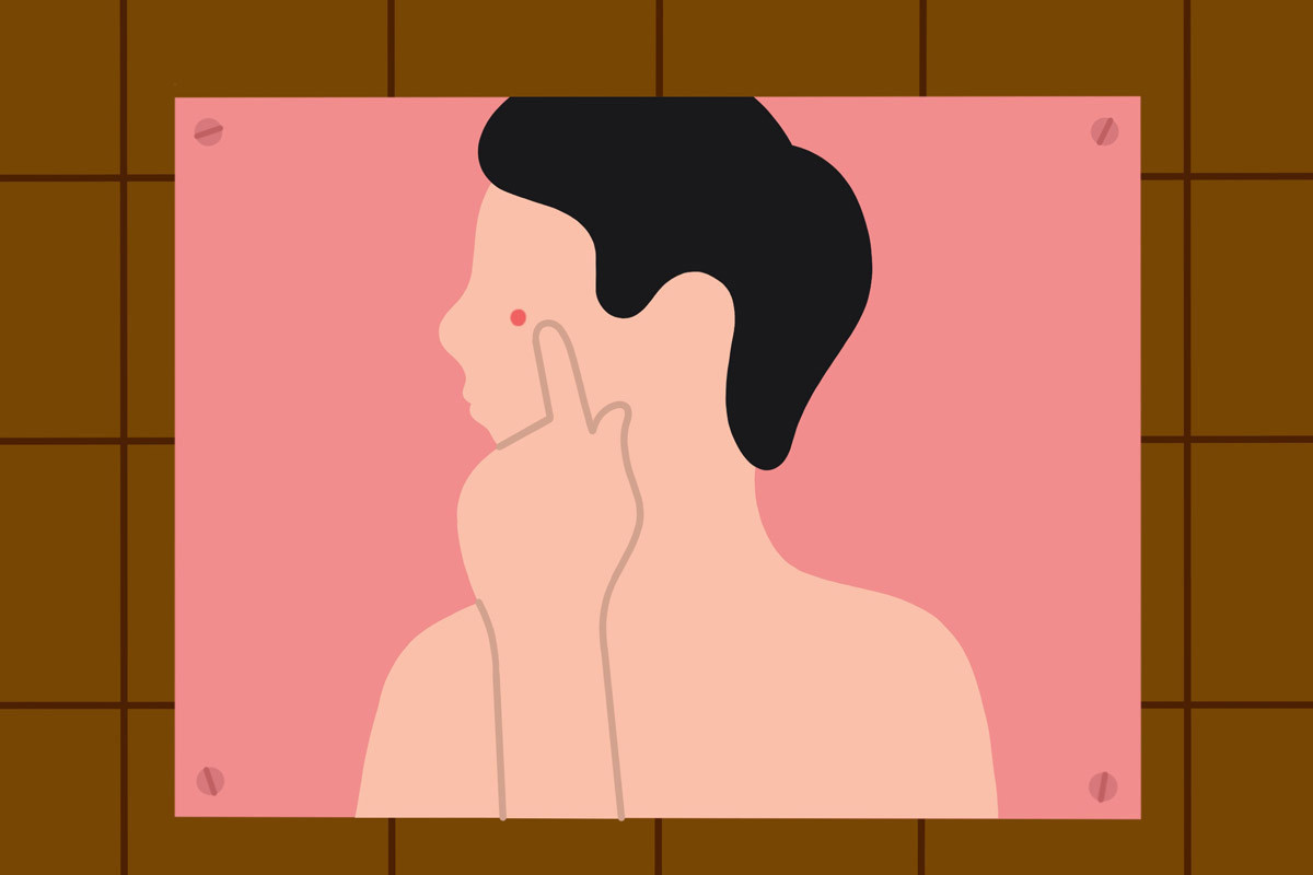 how-to-cure-acne-hair-loss