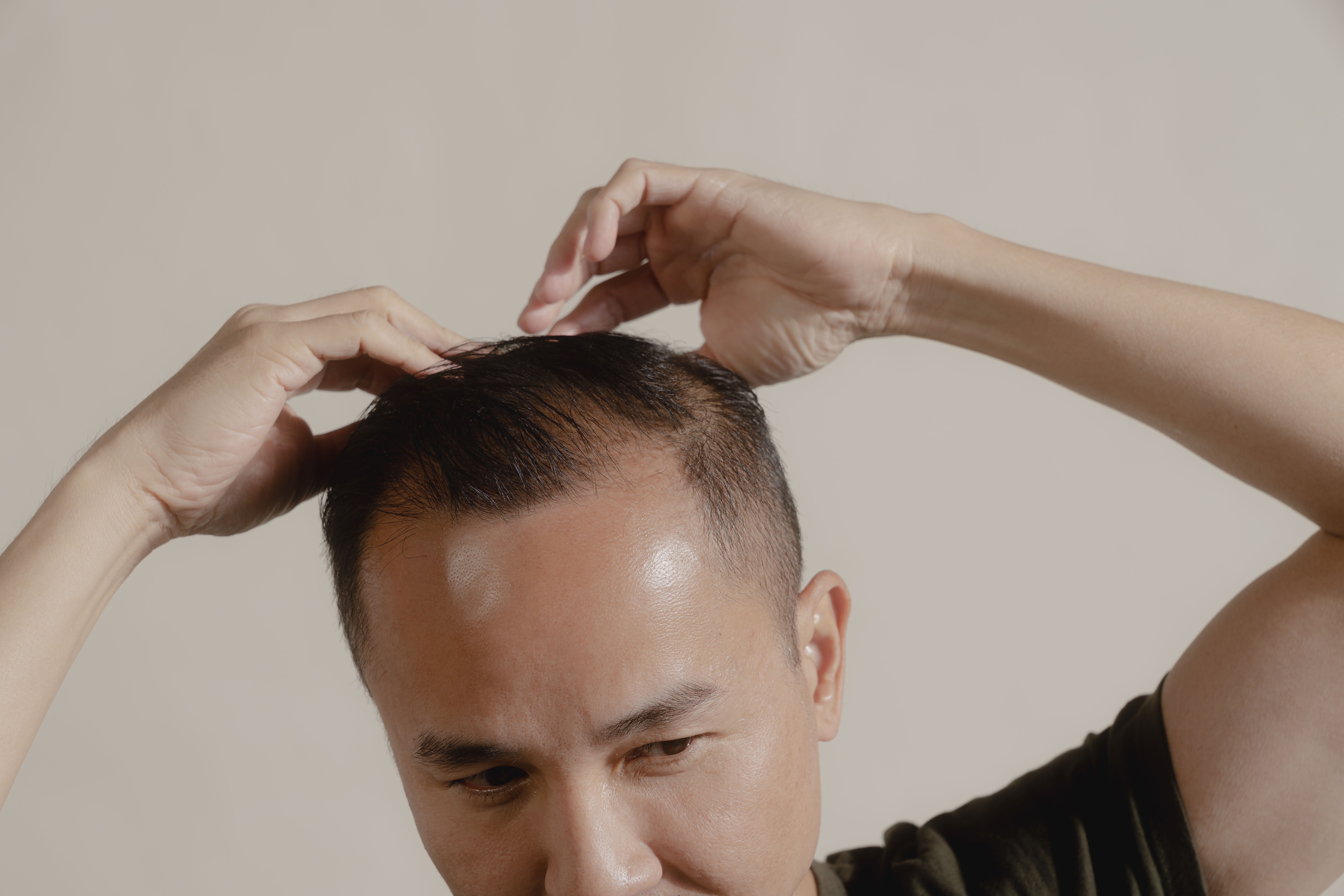 hair loss stress